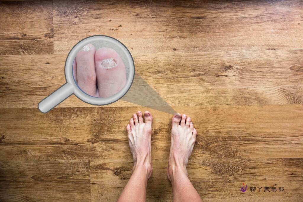 認識灰指甲，哪些是發病的高危險群？ - 封面圖