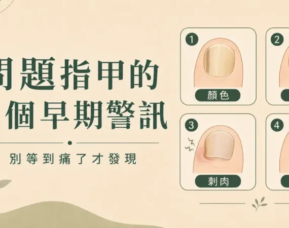 問題指甲辨識：4 個早期警訊圖解，包含顏色改變、甲片增厚、甲緣刺肉與橫向凹溝
