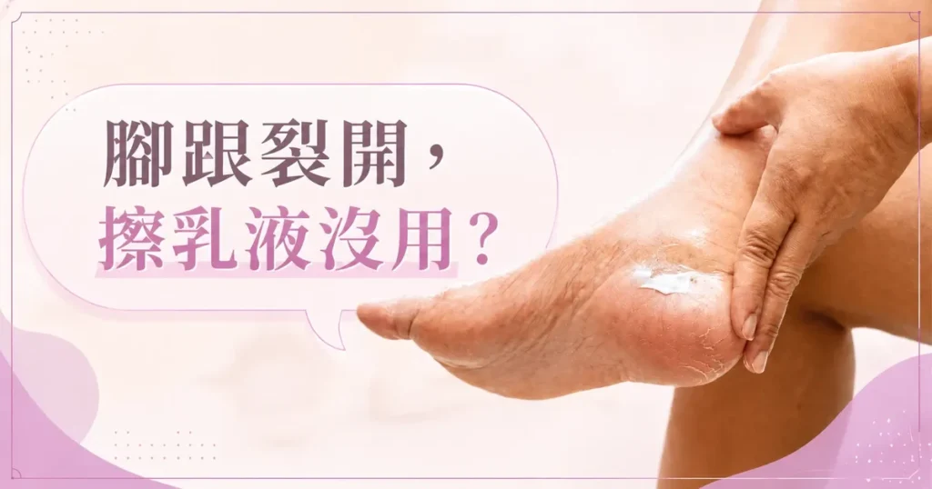 赤足腳跟側面與一罐乳霜並置的居家照片，帶出腳跟龜裂與保養品選擇的主題。