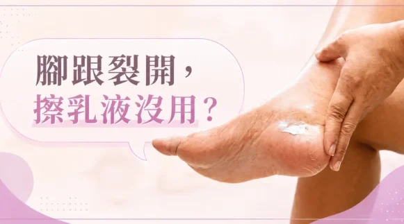 赤足腳跟側面與一罐乳霜並置的居家照片，帶出腳跟龜裂與保養品選擇的主題。