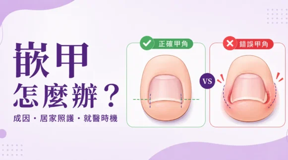 嵌甲處理：成因、居家照護與就醫時機