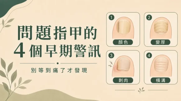 問題指甲辨識：4 個早期警訊圖解，包含顏色改變、甲片增厚、甲緣刺肉與橫向凹溝